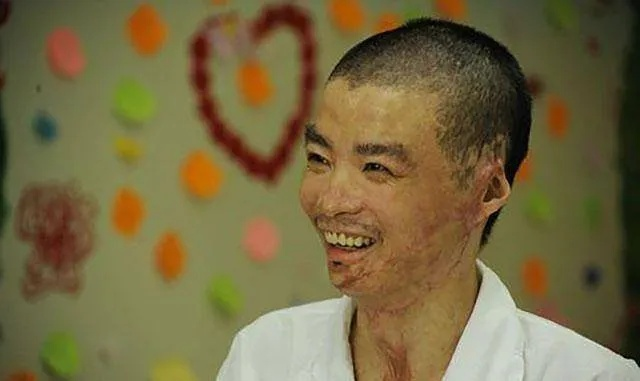 烈火中的守护神，丈夫两度冒险救妻，双双烧伤英勇无畏