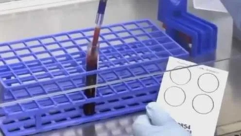 顺德发现珍稀百倍钻石血，超越熊猫血罕见程度
