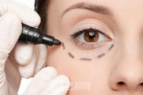 眼睛抽脂手术，美丽背后的风险权衡