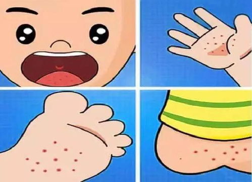认识手足口病症状，为孩子健康保驾护航