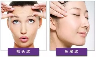 十年除皱针，岁月魔法与潜在代价的深度剖析