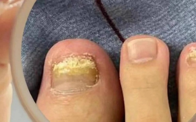 灰指甲治疗全攻略，解析与应对